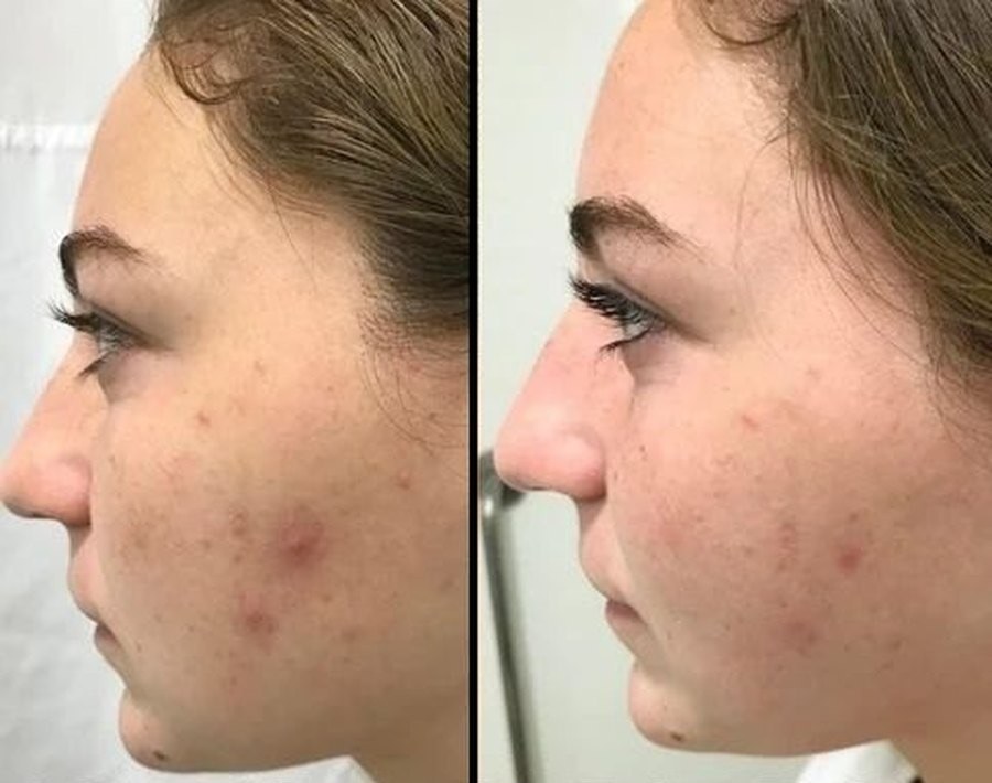 Before and after: acne and redness on the cheek, collagen and vitamin C infusion