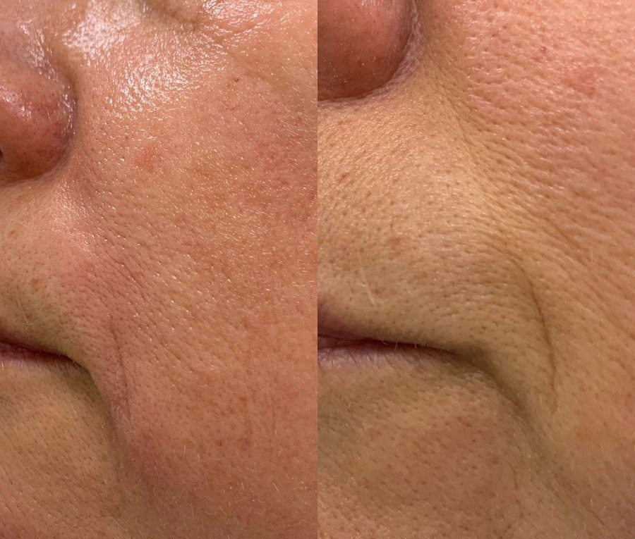 Before and after one Collagenizer NEO treatment: cheek and nose-to-mouth line, redness and texture visibly calmer