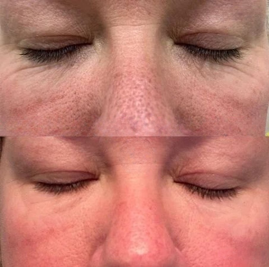 Before and after: redness and rough texture around the eyes and nose, collagen infusion