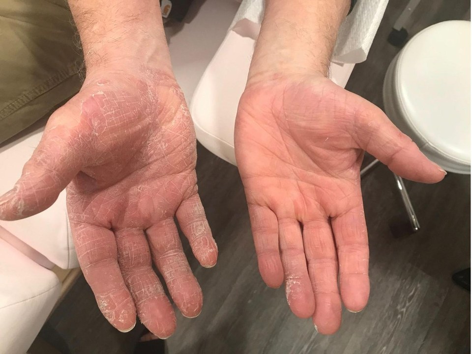 Before and after: severely dry, cracked palms, Collagenizer NEO with collagen