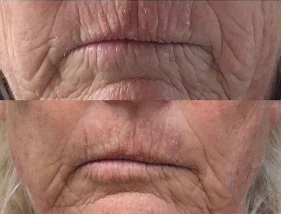 Before and after: lines around the mouth, collagen infusion