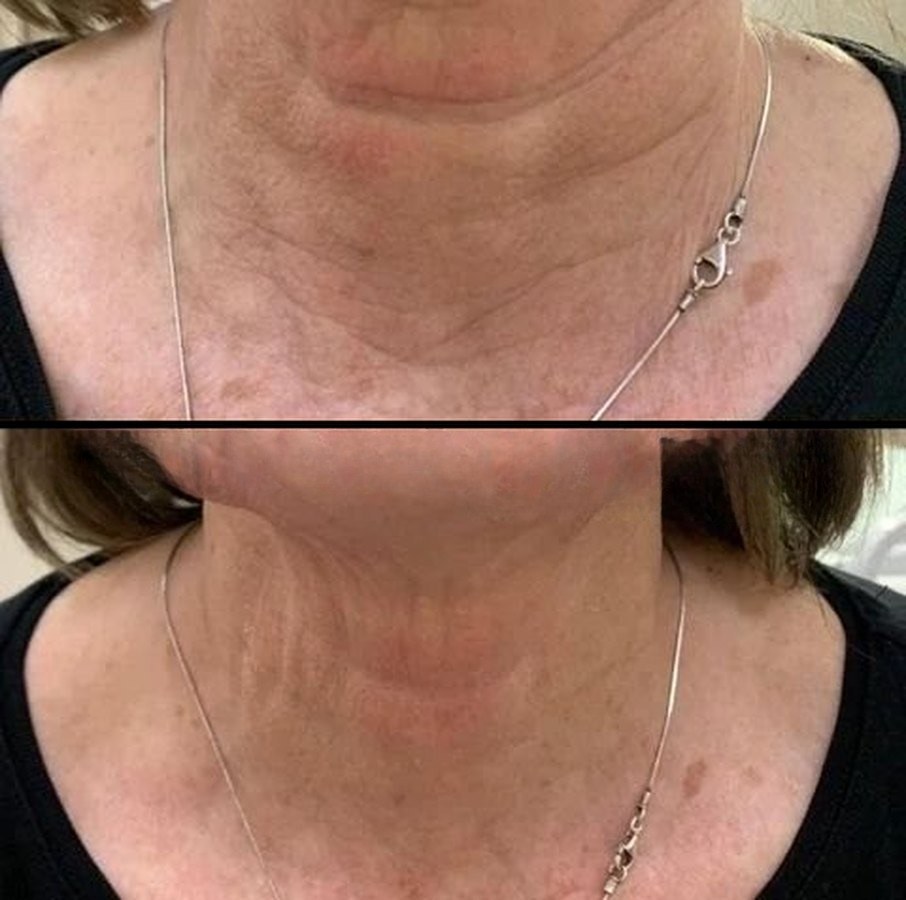Before and after: neck lines and laxity, collagen infusion
