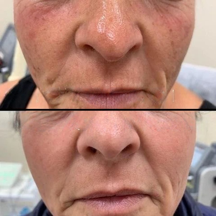 Before and after: sun damage, pores and pigment across the nose and cheeks, photofacial with collagen infusion